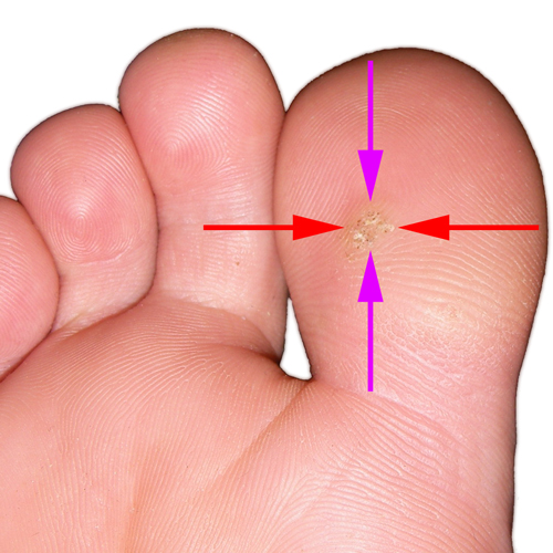 pinch-test-plantar-wart